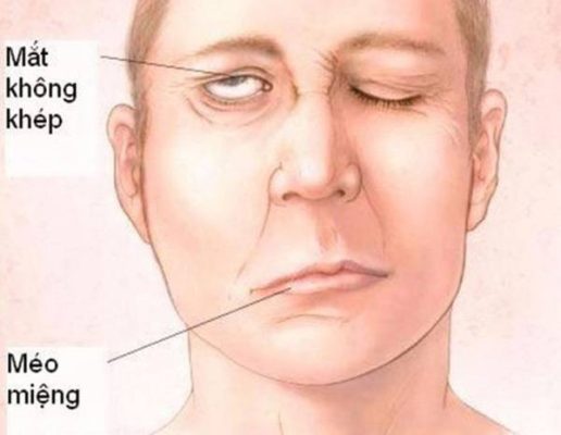 Nguyên nhân, dấu hiệu và cách xử trí di chứng tai biến méo miệng