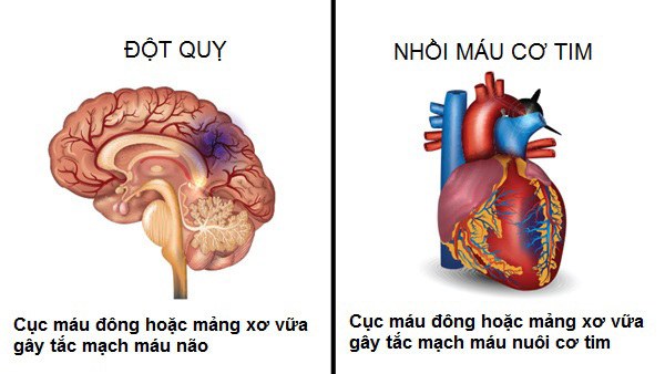 Phân biệt đột quỵ não và đột quỵ tim khác nhau như thế nào