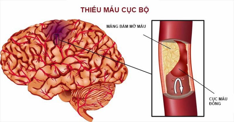 Cần làm gì để phục hồi sau nhồi máu não?