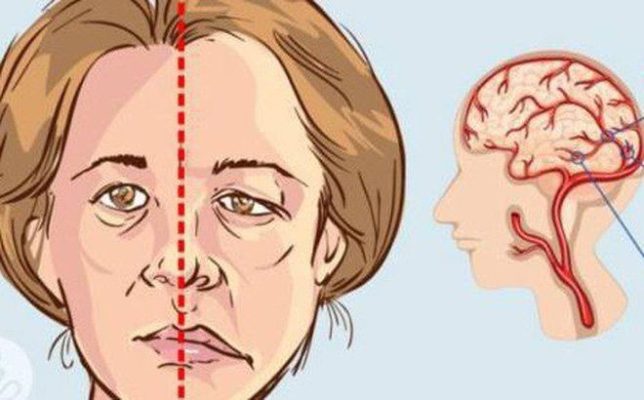 Đừng chủ quan với chứng rối loạn thị giác sau tai biến